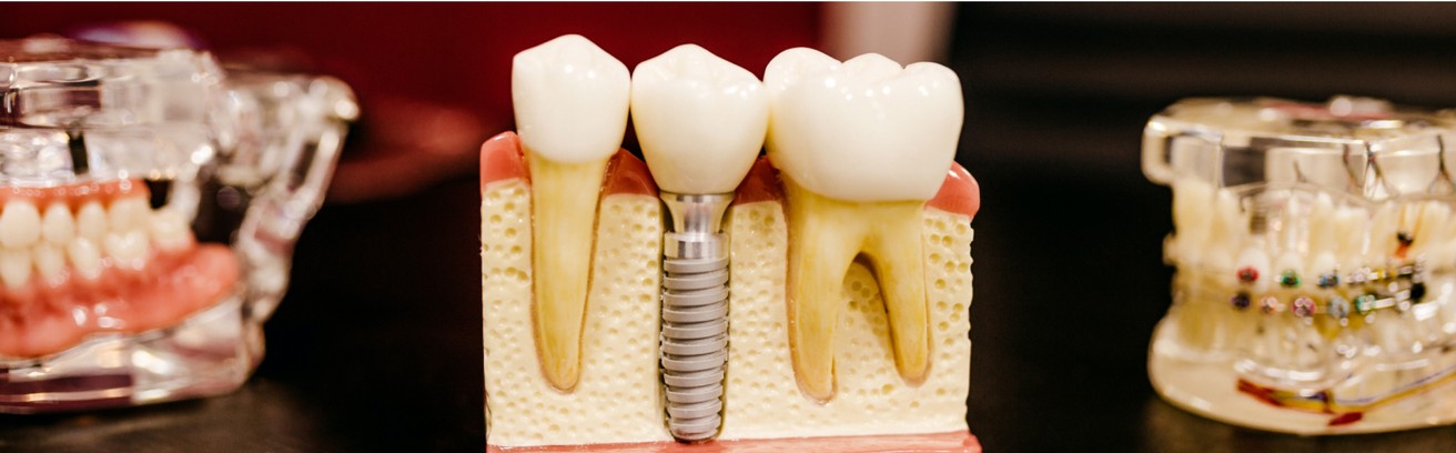 dental implants