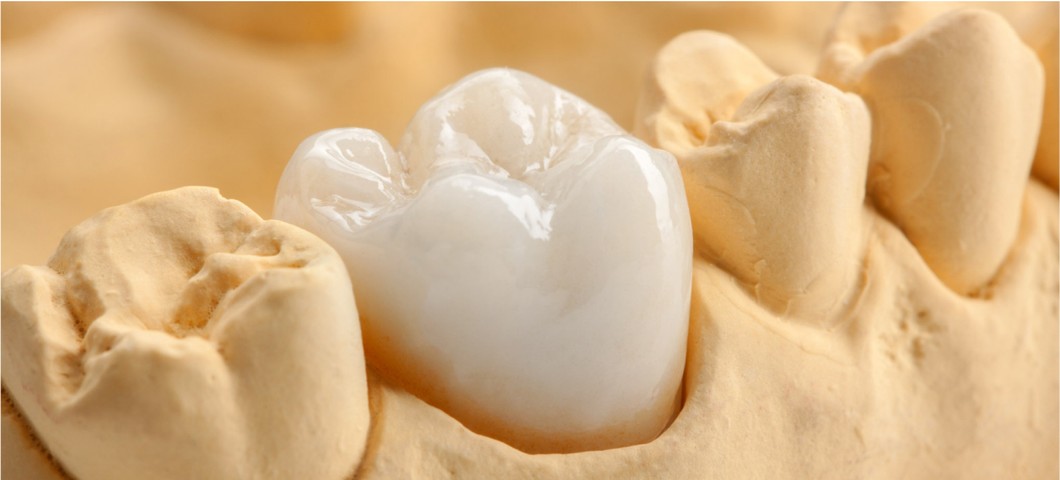 dental crowns