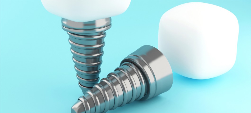 dental implants